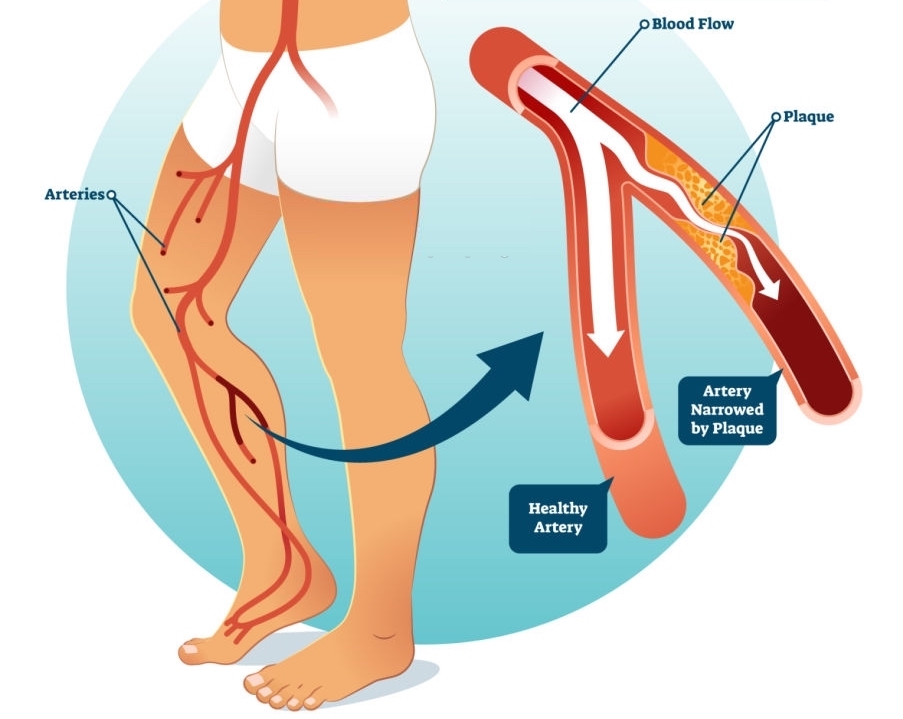 Can You Exercise With Peripheral Artery Disease